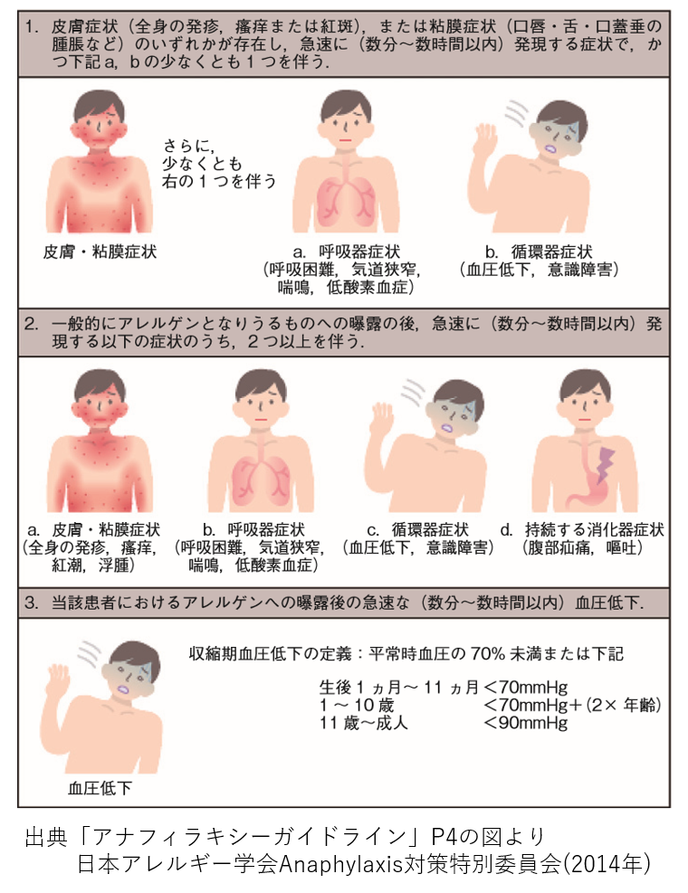 アレルギー 症状 エビ エビ、カニ｜代表的な食物アレルゲン｜原食物アレルギー｜因別アナフィラキシー｜アナフィラキシーってなあに.jp｜マイランEPD 合同会社